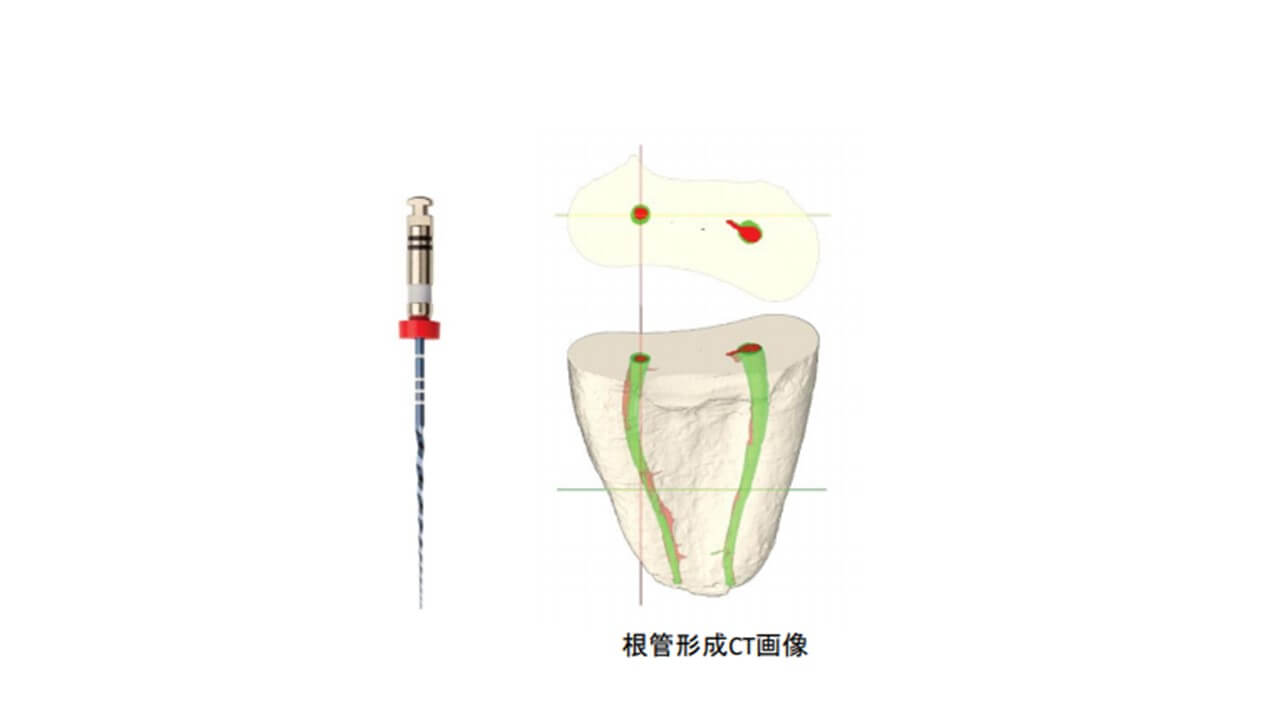歯科用マイクロスコープを用いた歯内療法（根っこの治療）
